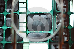 Teeth x-ray under a magnifying glass