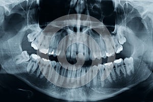 Teeth xray