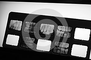 Teeth XRay in Lightbox