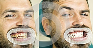 Teeth yellow vs white, before or after whitening. Man with isolated background touching mouth with painful expression