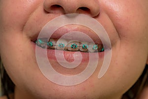 TEETH OF YOUNG WOMAN WITH ORTHODONTIC TREATMENT