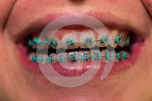 TEETH OF YOUNG WOMAN WITH ORTHODONTIC TREATMENT