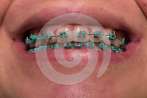 TEETH OF YOUNG WOMAN WITH ORTHODONTIC TREATMENT