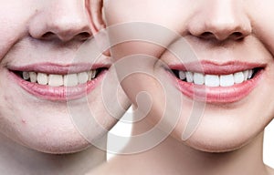 Teeth of young woman before and after whitening.