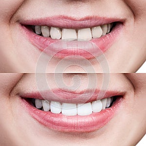 Teeth of young woman before and after whitening.