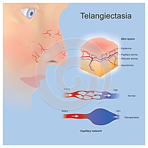 Telangiectasia. Problem tiny blood vessels widened or formed located near surface skin layers photo