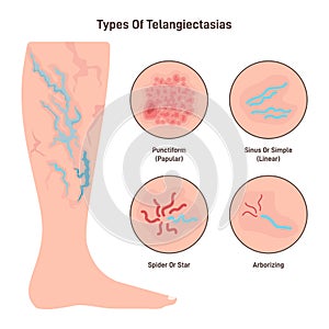 Telangiectasia types set. Varicose veins pattern, dilated blood vessels photo