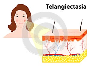 Telangiectasias. Spider veins or angioectasias photo