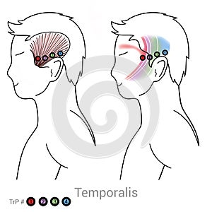 Temporalis: Managing headache pain arriving from myofascial trigger points in the Temporalis