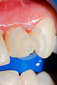 Temporary crown for tooth