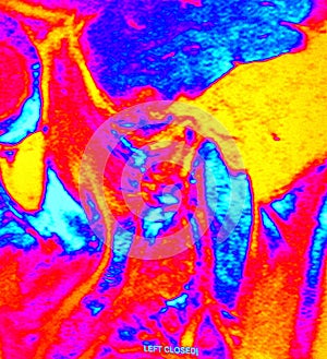 Temporomandibular joint dislocation articular disk