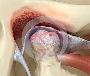 Temporomandibular joints arthritis and dislocated articular disc. Medically accurate 3D illustration