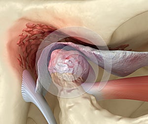 Temporomandibular joints arthritis and dislocated articular disc. Medically accurate 3D illustration