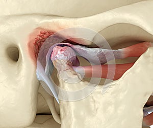 Temporomandibular joints arthritis and dislocated articular disc. Medically accurate 3D illustration photo