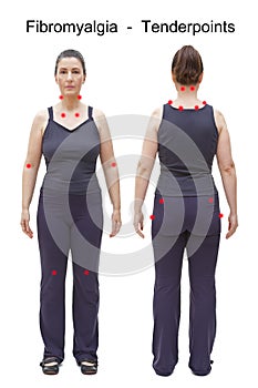 Tender points fibromyalgia body woman