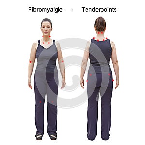 Tenderpoints fibromyalgie body woman german photo