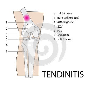 Tendinitis knee injury