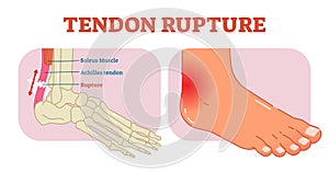 Tendon rupture anatomical example, vector illustration diagram, educational medical scheme.