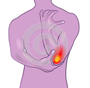 Tennis elbow illustration