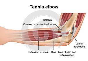 Tennis elbow injury medical  illustration on white background