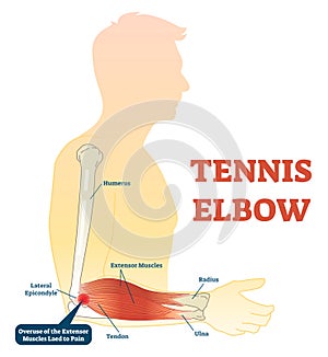 Tennis elbow medical fitness anatomy vector illustration diagram with arm bones, joint and muscles. photo