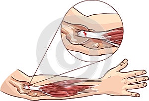 Tennis elbow - tear in the common extensor tendon of the arm