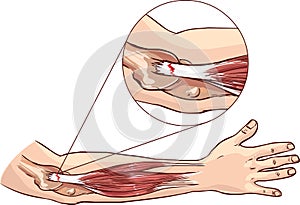 Tennis elbow - tear in the common extensor tendon of the arm photo