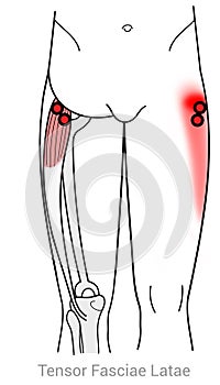 Tensor Fasciae Latae: Managing pain arriving from myofascial trigger points in the Tensor fasciae latae muscle