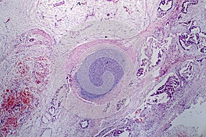 Teratoma, light micrograph photo