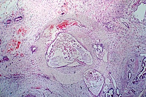 Teratoma, light micrograph photo