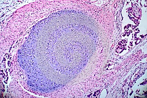 Teratoma, light micrograph photo