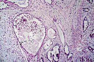 Teratoma, light micrograph photo