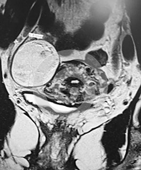 Teratoma rare ovarian pathology mri exam