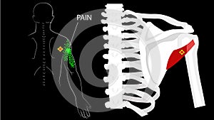 Teres minor muscle. Trigger points and referred pain in the arm and shoulder