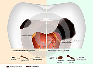 Tertiary dentin formation. Reparative dentinogenesis and Reactive dentinogenesis. Odontoblast and Dental pulp stem cell photo