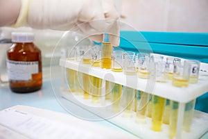 Test tubes with urine tests in a medical biochemical