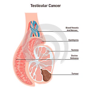 Testicular cancer. Pathological malignant tumor develops in the testicles.