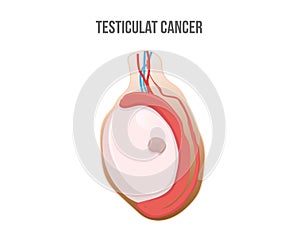 Testicular cancer vector illustration