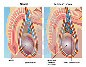 Testicular torsion photo