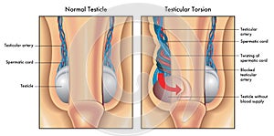 Testicular torsion photo