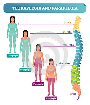 Tetraplegia and paraplegia spinal neural disorder medical vector illustration diagram with female back bone cross section.