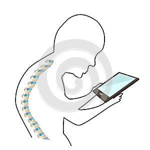 Text Neck Syndrome. Spinal curvature, kyphosis, lordosis of the neck, scoliosis, arthrosis. Improper posture and stoop