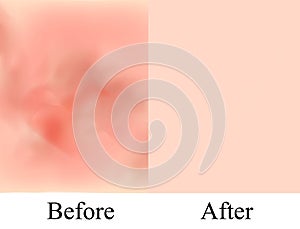 Texture, inflamed pimples and acne. Before After acne cysts. Skin background. Infographics. Vector illustration on