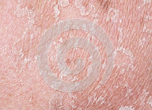Texture of irritated pigmented skin covered with cracks and scales after sunburn