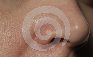 Texture of problematic human skin with large-looking open pores, acne scars and nasolabial fold