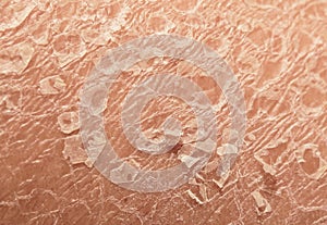 Texture of the unhealthy human skin epidermis with flaky and cr photo