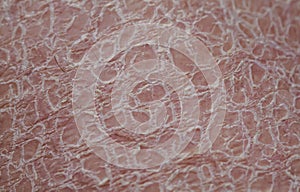 Texture of women`s skin close-up covered with small and large cracks and dead dry flaky scales