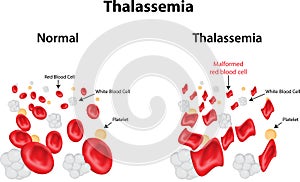 Thalassemia