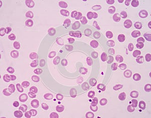 Thalassemia blood picture.