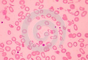 Thalassemia blood smear abnormal red blood cells morphology.